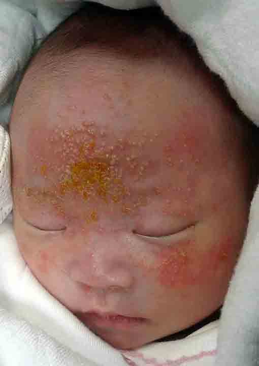 乳児脂漏性皮膚炎